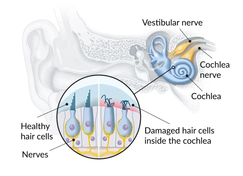 Image showing Healthy vs Damaged hair cells inside the cochlea. Damaged hair cells can cause sensorineural hearing loss.